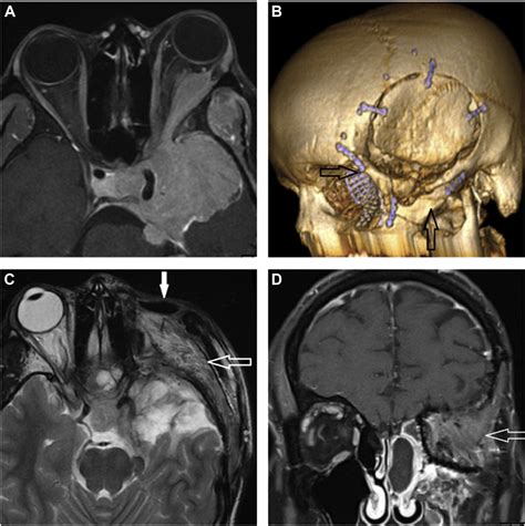 Neurosurgical Approaches To The Skull Base Neuroimaging Clinics