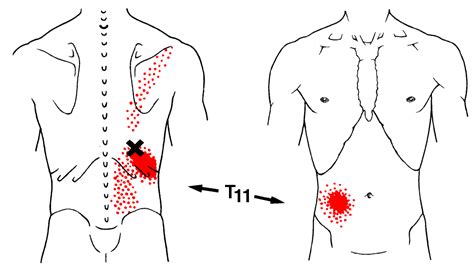 Iliocostalis Thoracis The Trigger Point And Referred Pain Guide