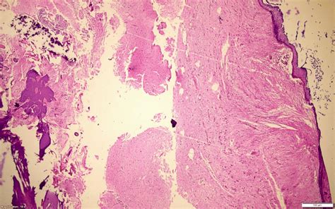Section Shows Cyst Lined By Keratinized Stratified Squamous Epithelium