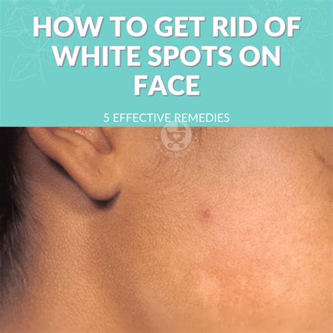 How To Get Rid Of White Spots On The Face 5 Most Effective Solutions