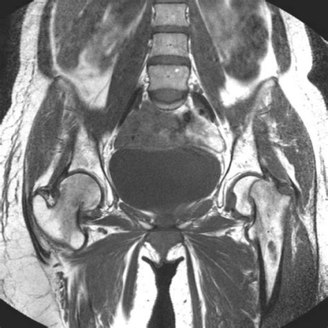 T1 Weighted Coronal Mri Scan Of The Pelvis Post Partum Open I