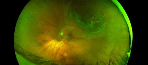 Retinal Detachment With A Chronic Appearing Operculated Tear Retina