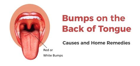 Bumps On Back Of Tongue Common Causes And Home Remedies Daily Health Cures