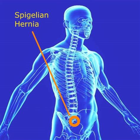 Spigelian Hernia Anatomy