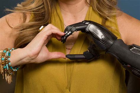 Finger And Partial Hand Prosthetic Options Arm Dynamics