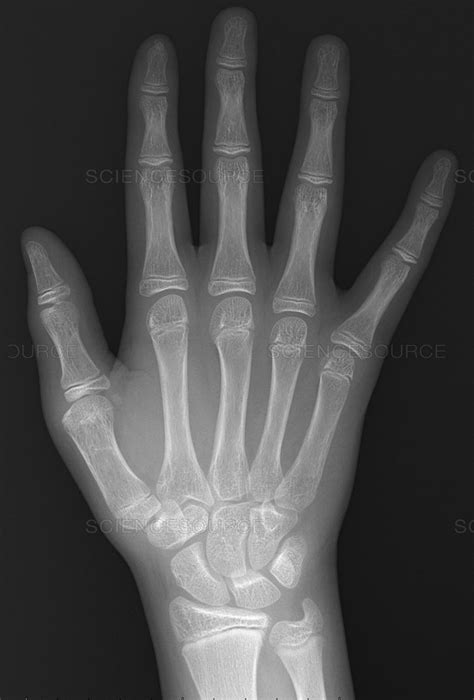 By dr arun pal singh. Science Source - Normal hand of 13 year old, X-ray