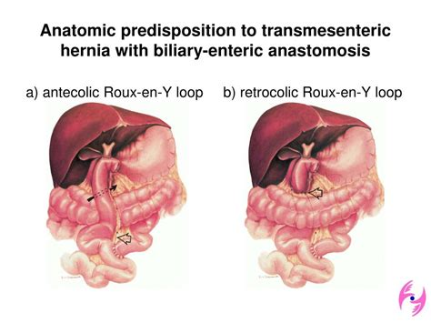 Ppt Internal Hernia A Brief Review Of Its Clinical Features And