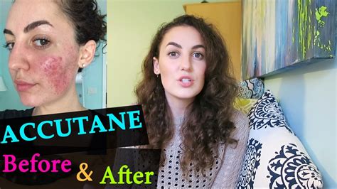 ACCUTANE BEFORE AFTER My Accutane Experience YouTube