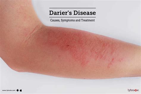 Dariers Disease Causes Symptoms And Treatment By Dr S K Kashyap