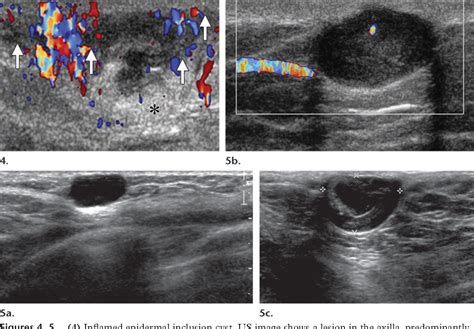 Figure 4 From Distinguishing Breast Skin Lesions From Superficial