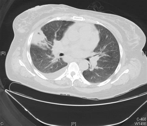 Pulmonary Infarction Right Lung Case 209 The Infarct In T Flickr