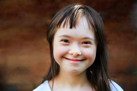 Researchers Uncover The Genetics Driving Facial Changes In Down Syndrome