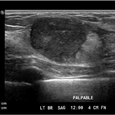 Ultrasound Of Right Breast Showing A Heterogeneous Hypoechoic Nodule