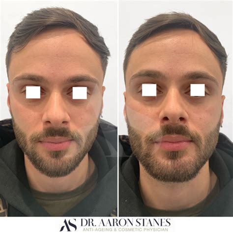 Male Chin Example 10 Dr Aaron Stanes Anti Ageing And Cosmetic Medicine