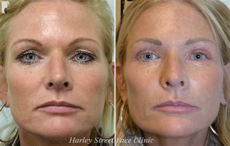 How To Get Rid Of Jowls With Fillers Non Surgical Remedies And Treatment The Harley Street