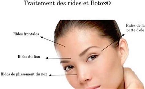 Ligne d'information provinciale sur les vaccins. Injections de toxine botulique sur les rides du visage