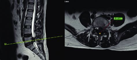T2 Axial Magnetic Resonance Imaging Cuts Of The Lumbar Spine Showing