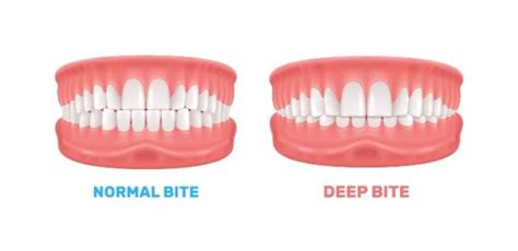 Overbite Heres Everything You Need To Know