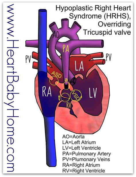 27 Best Hypoplastic Right Heart Syndrome Images On Pinterest