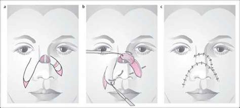 Cheek Flap Facial Plastic Surgery European Medical