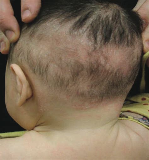 Traction Alopecia From Atopic Dermatitis Consultant360