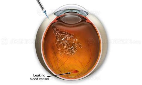 Intravitreal Injections Macular Degeneration