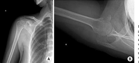 Figure 2 From Isolated Avulsion Fracture Of The Lesser Tuberosity Of