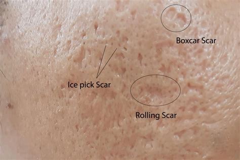 Ice Pick Acne Scars