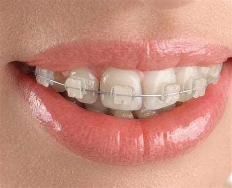 Clear Braces Types Benefits How To Clean