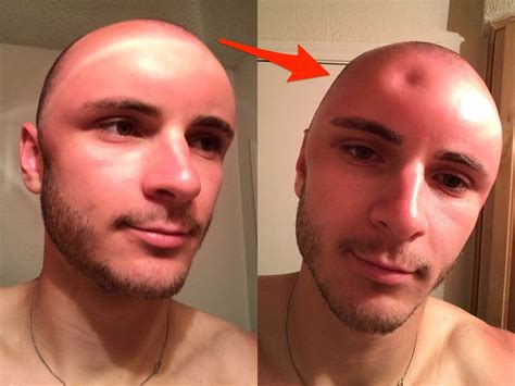 These Photos Of A Man S Swollen Sunburned Head Will Remind You Wear