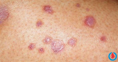 The Most Common Skin Problem In People With Diabetes Is Called Diabetic Dermopathy In Fact
