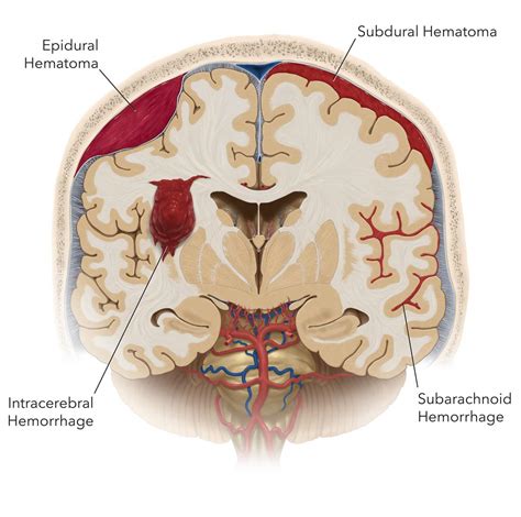 Subarachnoid Hemorrhage Vs Intracerebral Hemorrhage