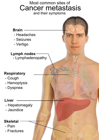 Maybe you would like to learn more about one of these? What is Metastsis Process and Its Routes | Bone and Spine