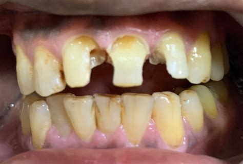 How to get rid of post braces stains. How to get rid of smoking stains on teeth?