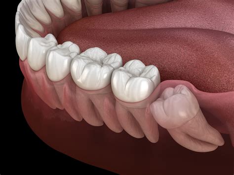 Should You Have Your Wisdom Teeth Removed Tuxedo Dental Group