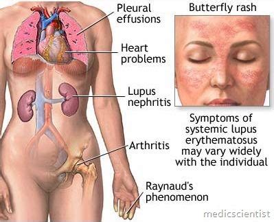 Systemic Lupus Erythematosus SLE Diagnosis Symptoms And Treatment MedicScientist Total