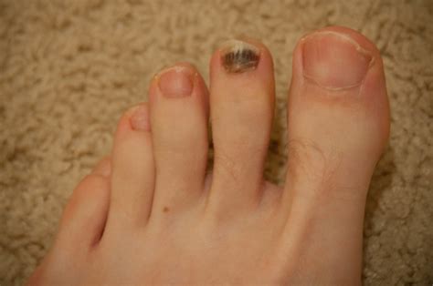 Cancer researchers have identified many of the major environmental factors that contribute to cancer, including smoking for lung cancer and sunlight for skin cancer. Dead Toenail | The distance runner's badge of honor. It ...
