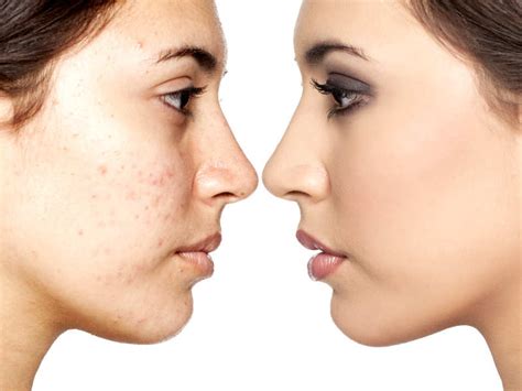 Maybe you would like to learn more about one of these? 5 home remedies to remove blemishes