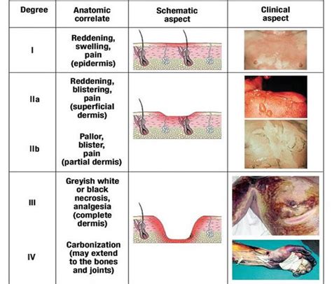 Burns Causes Symptoms Treatment Diagnosis And Prevention