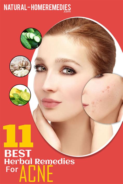 11 Best Herbal Remedies For Acne Natural Home Remedies And Supplements