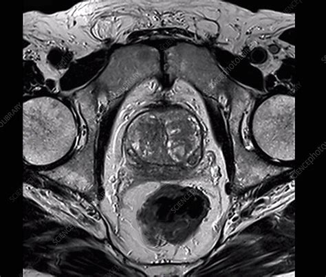 Benign Prostatic Hyperplasia Mri Scan Stock Image C0552703