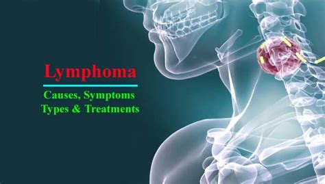 Lymphoma Definition Types Causes Symptoms And Treatments Lymphoma Lymphoma Awareness