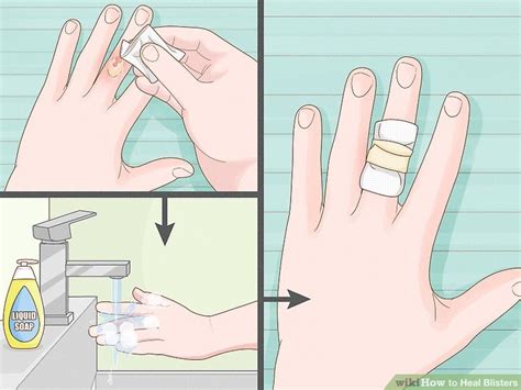 4 Ways To Heal Blisters Wikihow