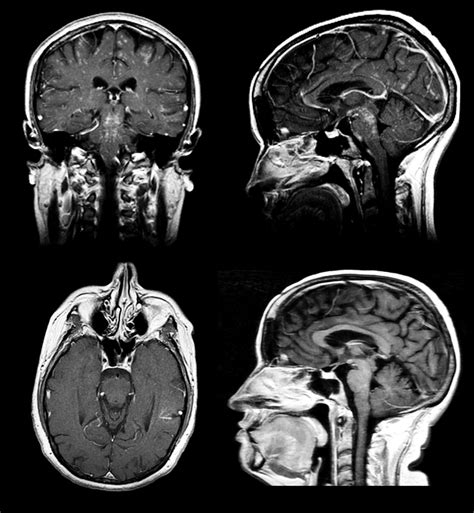 Index of biventricular interdependence calculated using cardiac mri: Síndrome CLIPPERS con distribución atípica de las lesiones ...