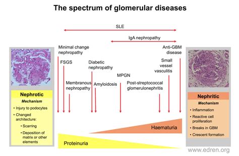 The Spectrum Of Glomerulonephritis Renal