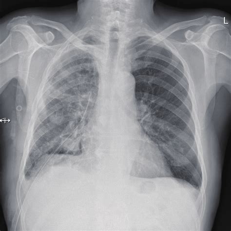 Pneumonia Surgery To Drain Lungs Best Drain Photos Primagem Org