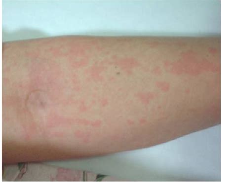 Figure 1 From Onset Of Adult Onset Stills Disease Following Influenza