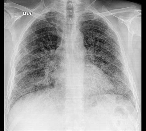 In this paper, detection of pneumonia infection by unsupervised fuzzy. Booklet: Interstitial Pneumonia Chest X Ray Findings
