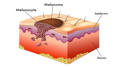 What Is Melanoma Skin Cancer Youtube