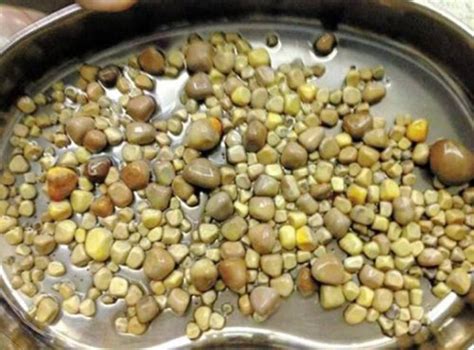 Man In China Has 420 Kidney Stones Removed As A Result Of Excessive